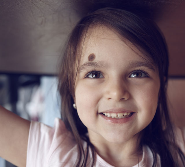 Hemangioma Birthmark small